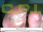 Hongos en las u&ntilde;as de los pies Onicomicosis tratamiento Zona Norte Podologia Uba Martinez