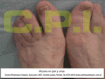 Hongos en los pies Onicomicosis podologos uba zona norte